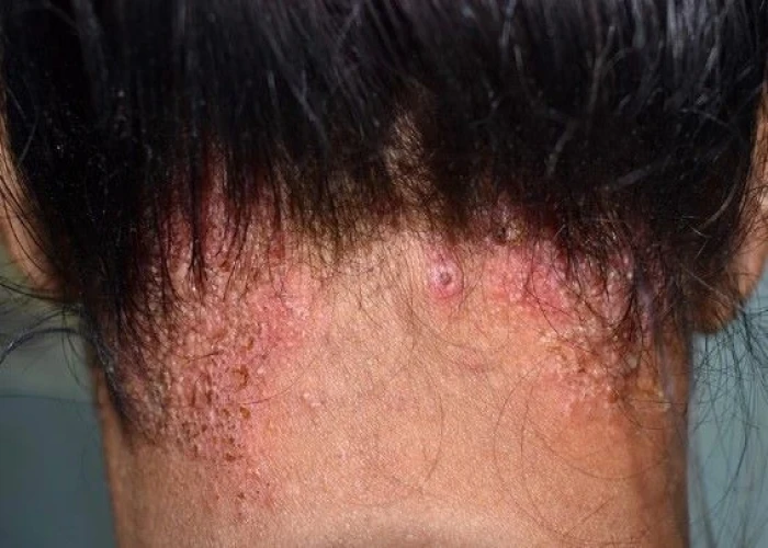 Ringworm (scalp)