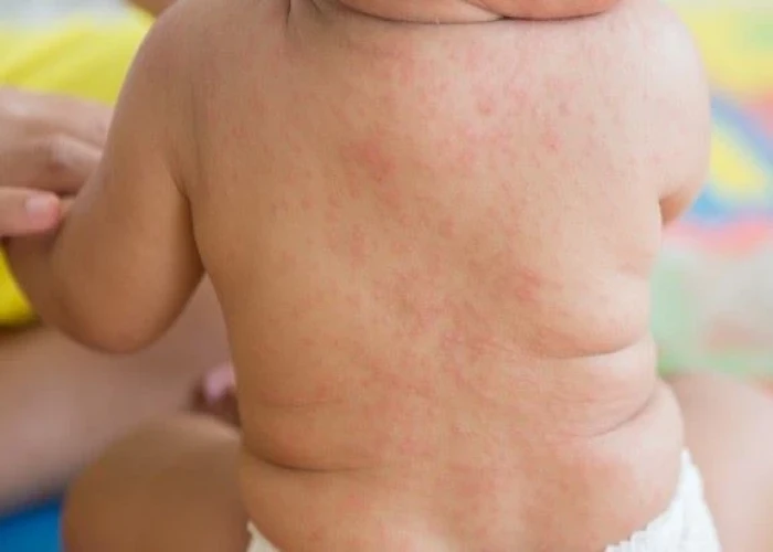 Roseola