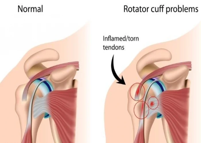 Rotator cuff injury