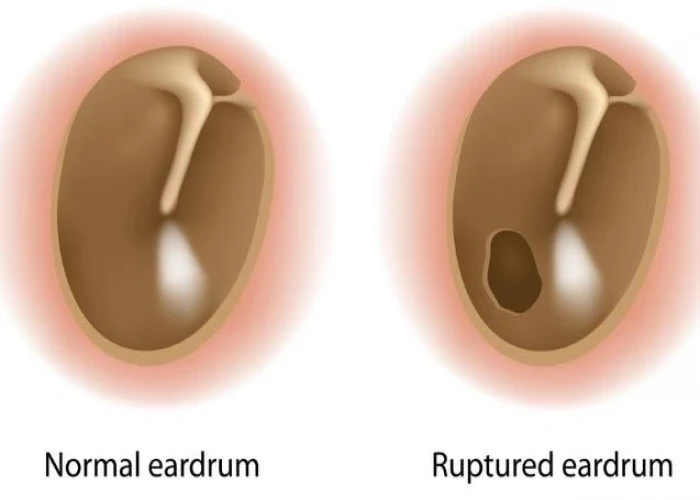 Ruptured eardrum (perforated eardrum)