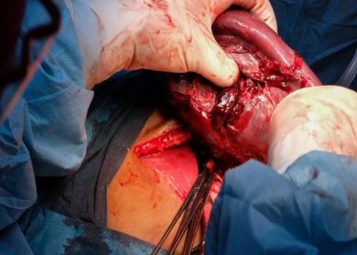 Ruptured spleen