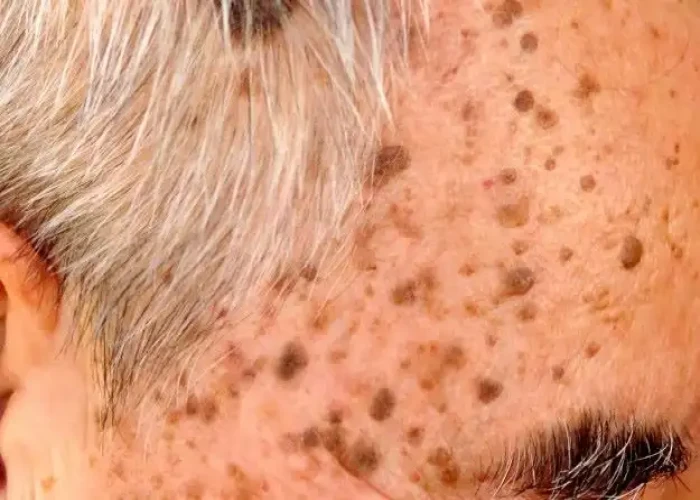 Seborrheic keratosis