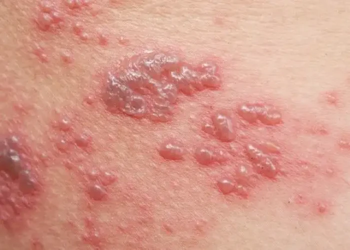 Shingles