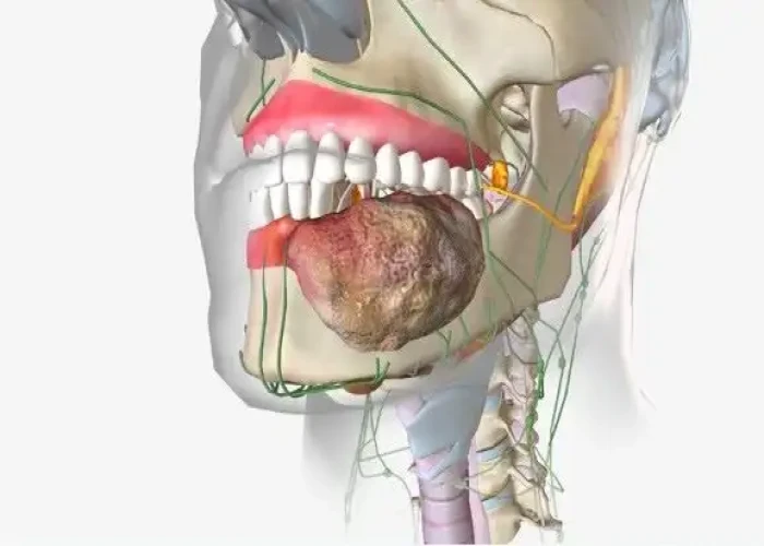 Soft palate cancer