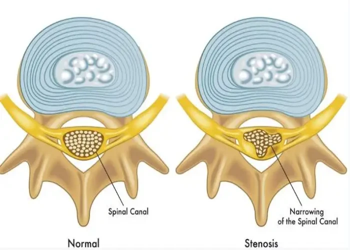 Spinal stenosis