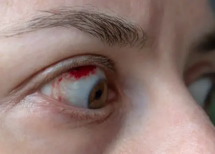 Subconjunctival hemorrhage (Broken blood vessel in eye)