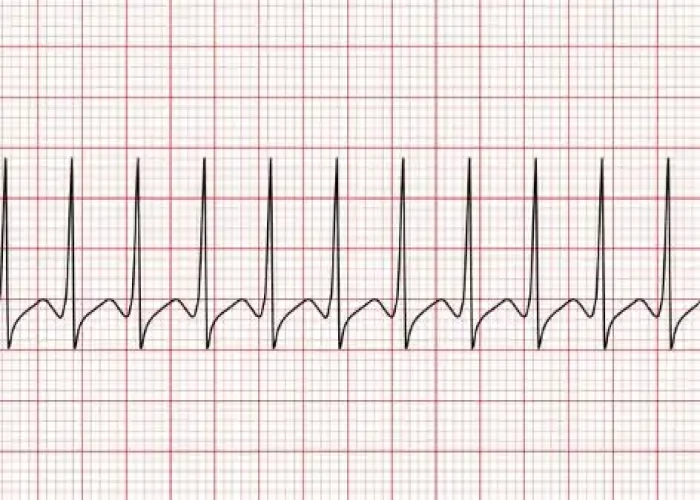 Supraventricular tachycardia