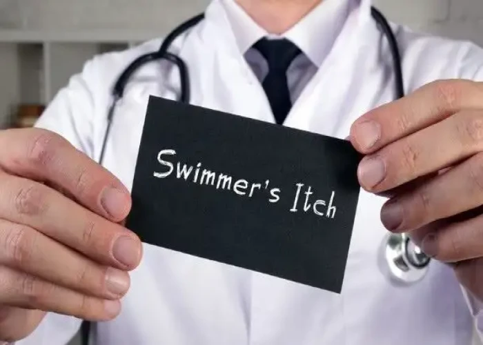 Swimmer's itch