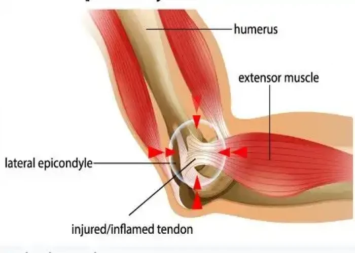 Tennis elbow