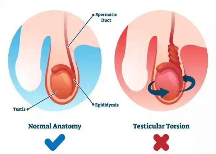 Testicular torsion