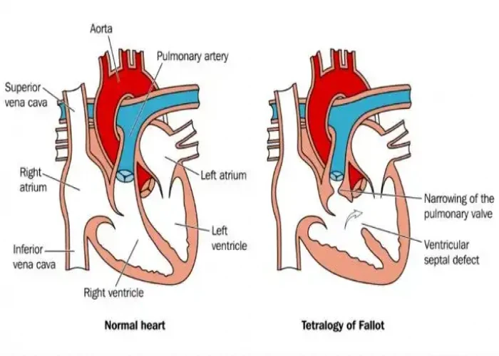 Tetralogy of Fallot