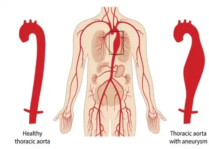 Thoracic aortic aneurysm