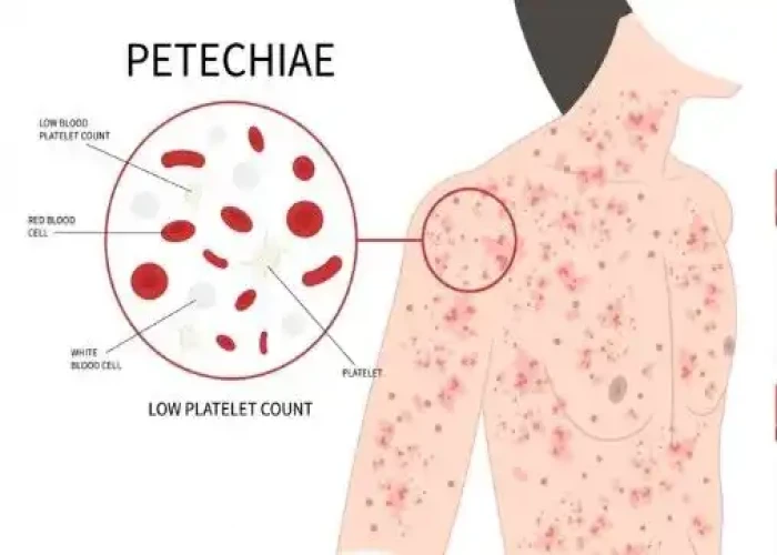 Thrombocytopenia (low platelet count)