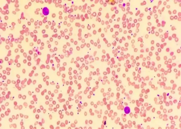 Thrombocytosis