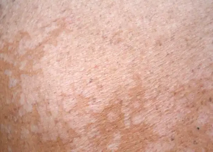 Tinea versicolor