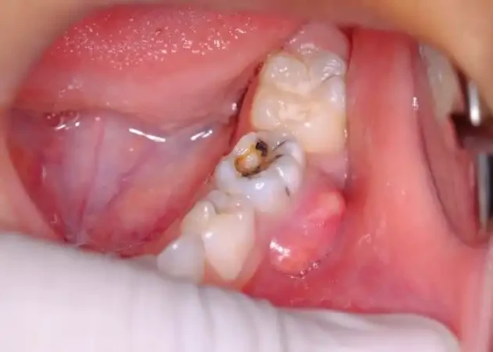 Tooth abscess