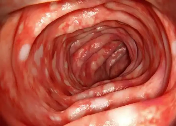 Ulcerative colitis