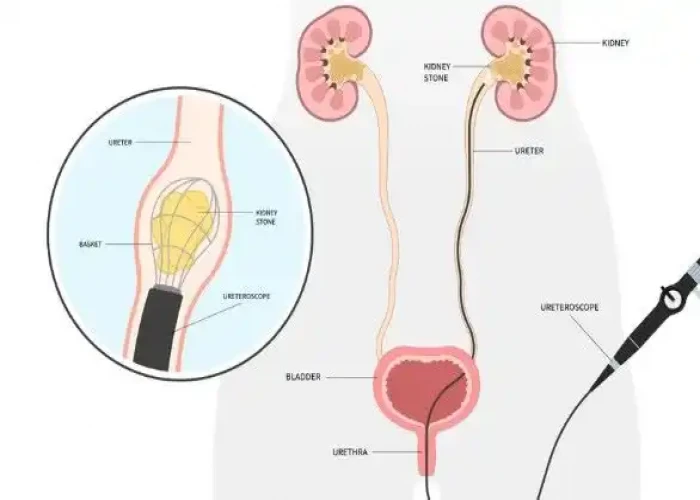 Ureteral obstruction