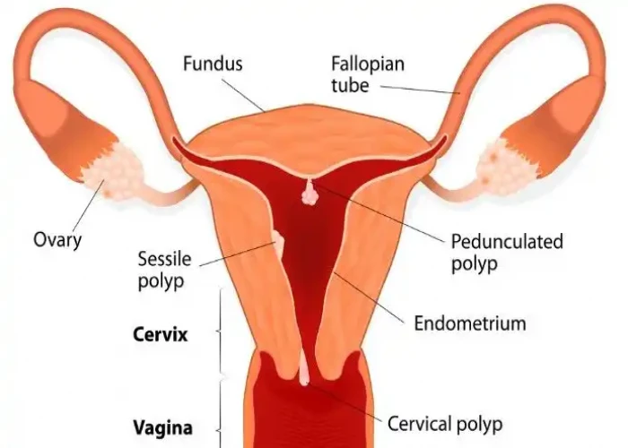 Uterine polyps