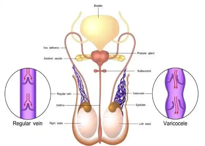 Varicocele