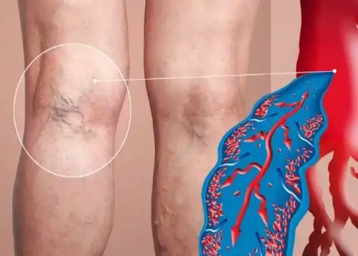 Varicose veins