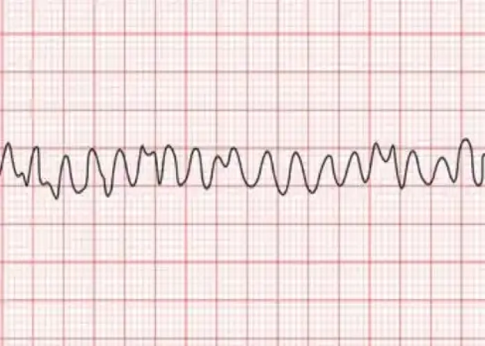 Ventricular fibrillation