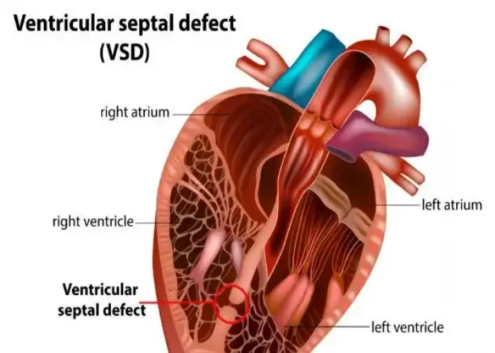 Ventricular septal defect (VSD)