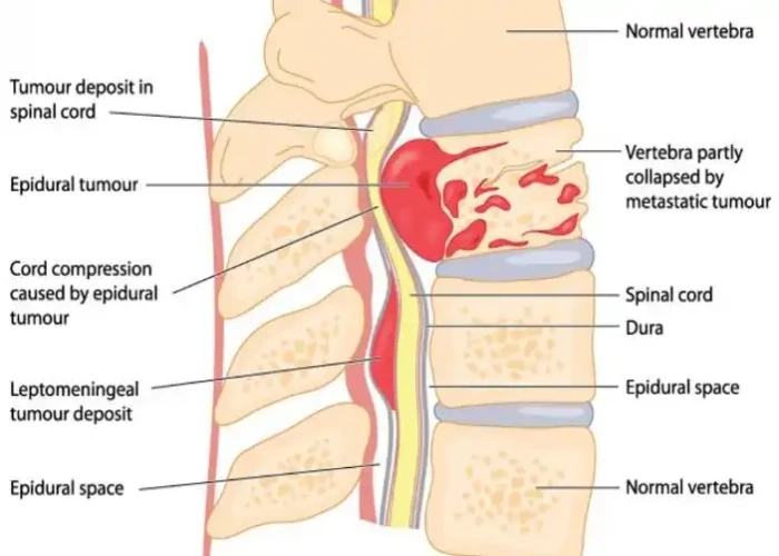 Vertebral tumor