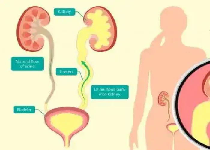 Vesicoureteral reflux