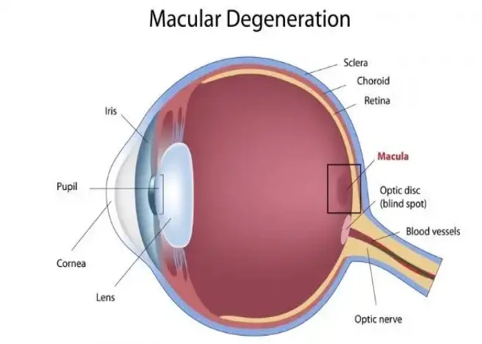 Wet macular degeneration