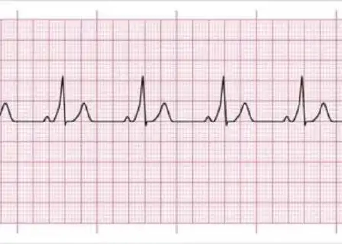 Wolff-Parkinson-White (WPW) syndrome