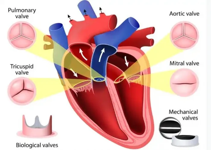 Tricuspid valve regurgitation