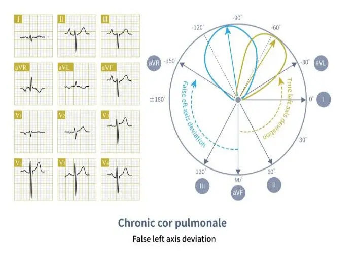 Cor Pulmonale