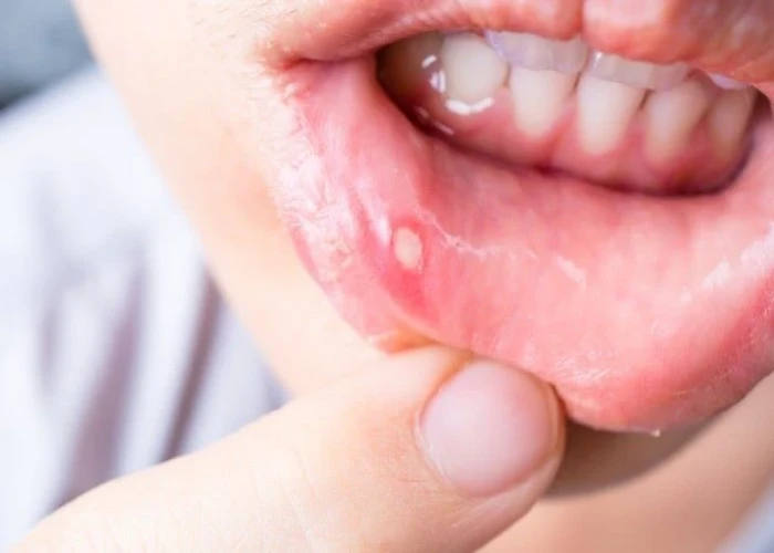 Mouth Ulcer