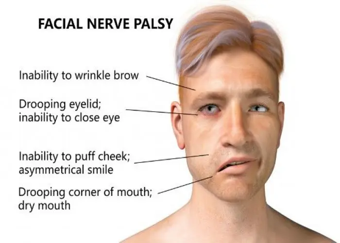 Facial palsy