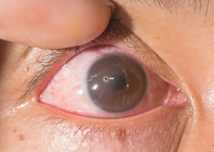 Foreign Body in eye