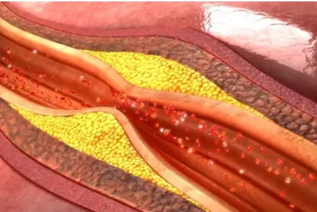 Artery disease