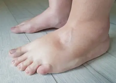 Edema