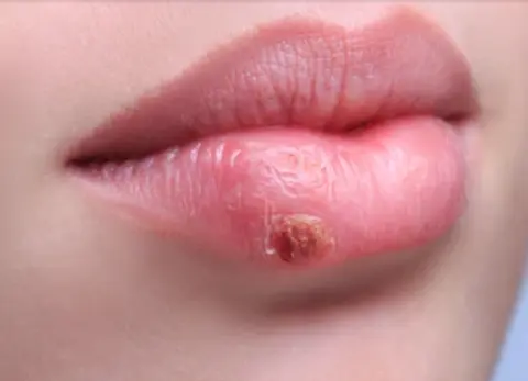 Lips disease