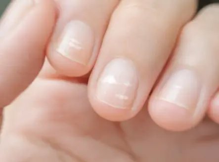 Nail disease