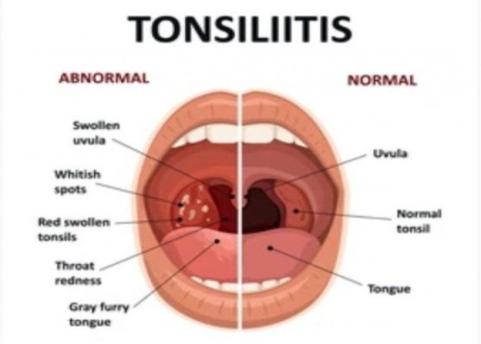 Tonsils