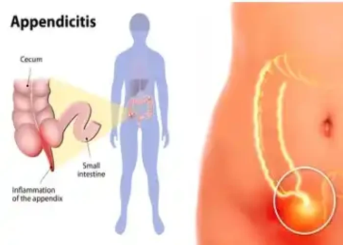 Appendicitis