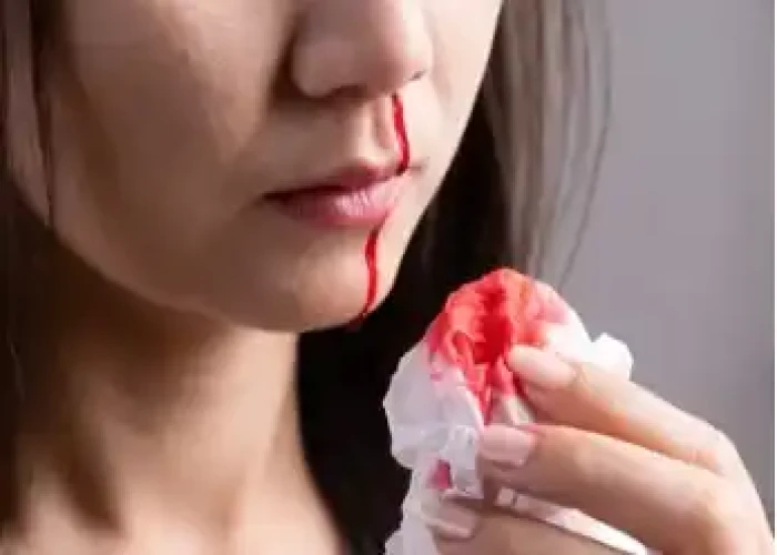 Bleeding from nose