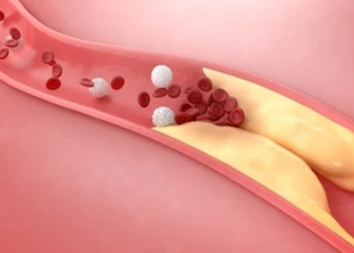 Coronary thrombosis