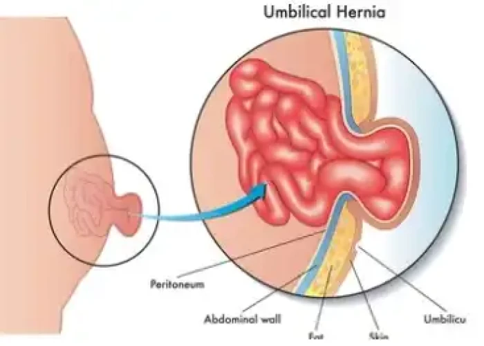 Hernia (Intestinal protrusion)