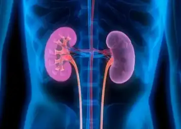 Kidney failure