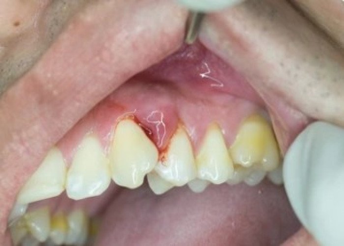 Gums disease