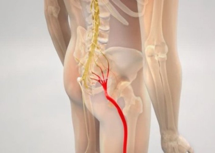 Sciatica