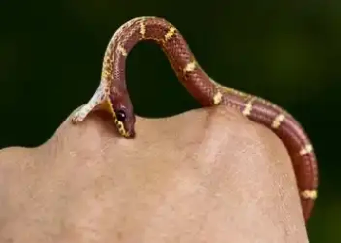 Snakebite