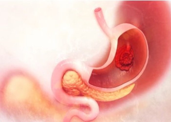 Stomach ulcer